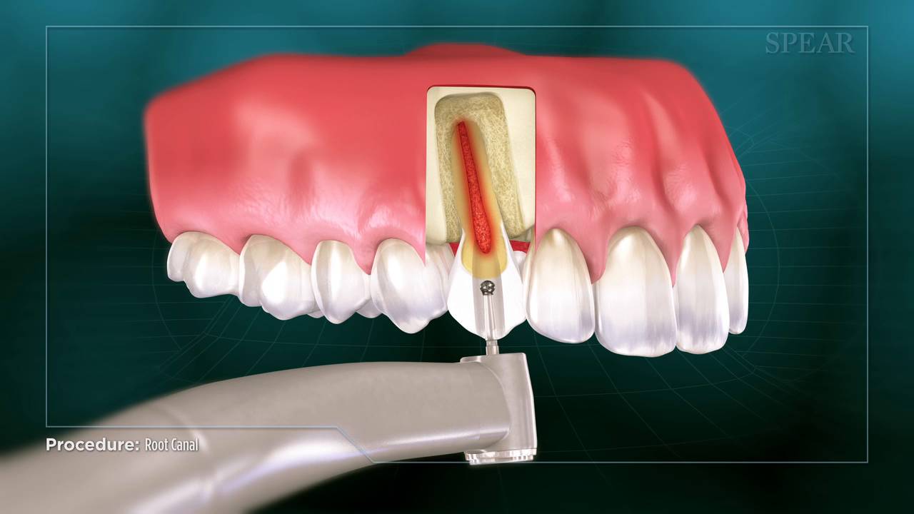 Restoration of teeth - methods. Treatment of canals Restoration of teeth - methods. Treatment of canals